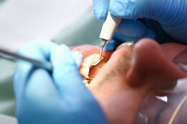 Best Emergency Treatment for Dental Infections or Abscesses in Memphis, MI